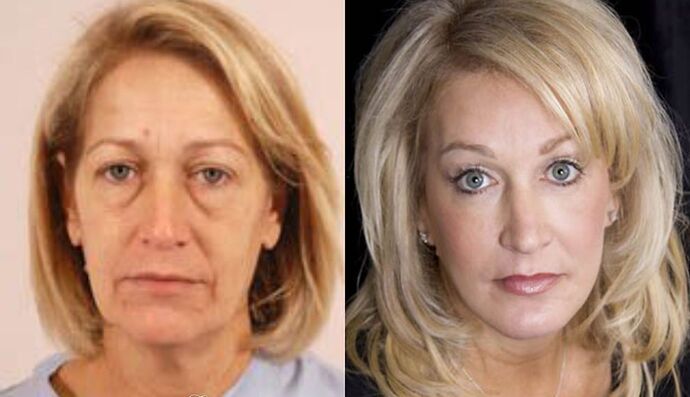 Chemical Peels: Case 1 - Before and After