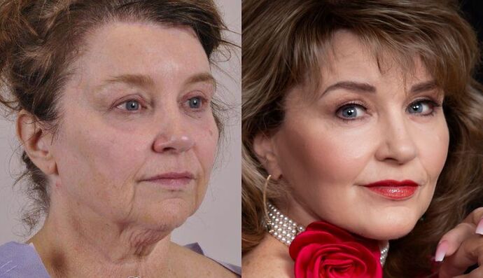 Dermabrasion: Case 1 - Before and After