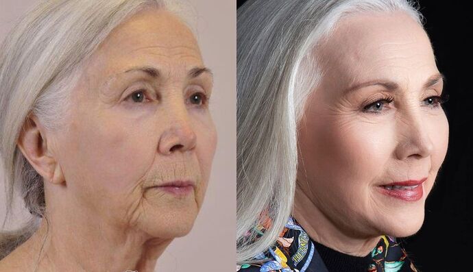 Dermabrasion: Case 2 - Before and After