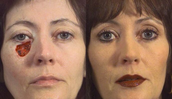 MOHS Reconstruction: Case 1 - Before and After