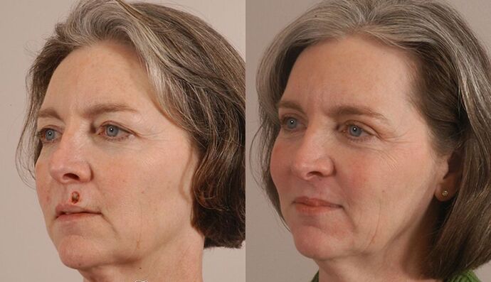 MOHS Reconstruction: Case 2 - Before and After