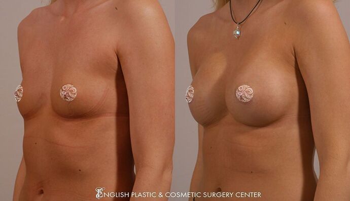 Breast Augmentation/Implants Case 1