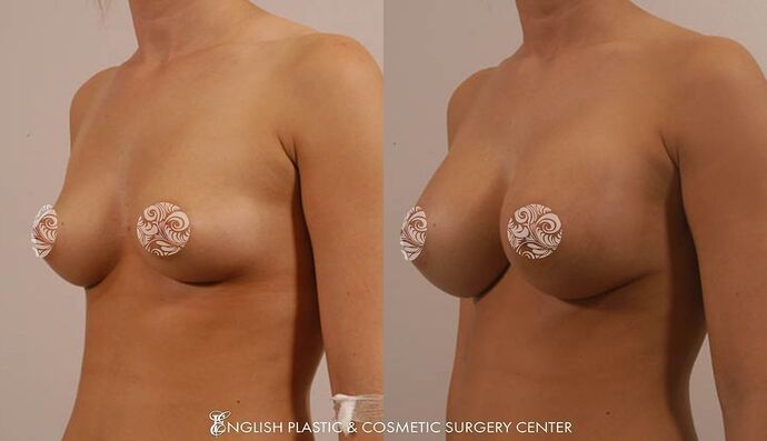 Breast Augmentation/Implants Case 2