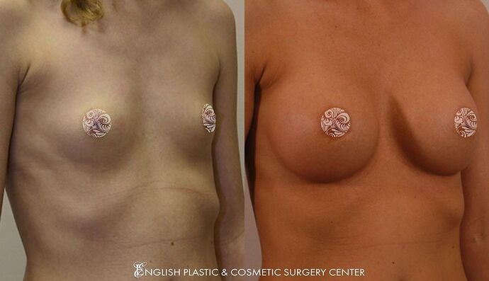 Breast Augmentation/Implants Case 3