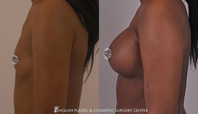 Breast Augmentation/Implants Case 4