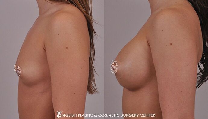 Breast Augmentation/Implants Case 5
