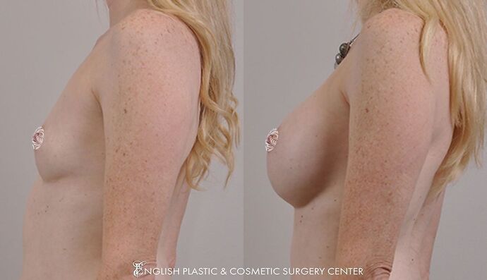 Breast Augmentation/Implants Case 6
