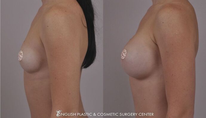 Breast Augmentation/Implants Case 7