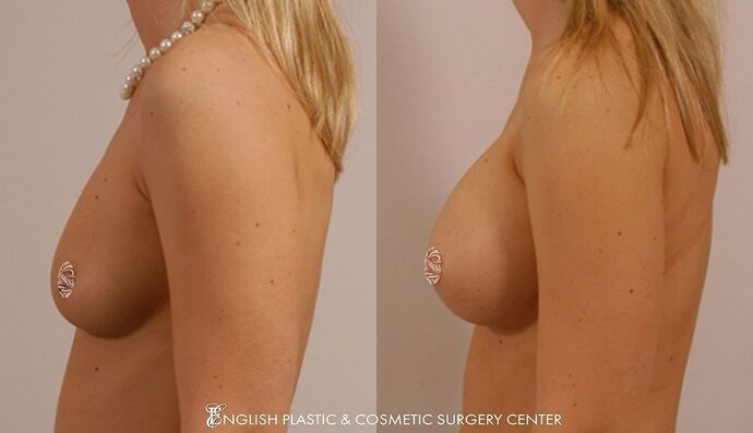 Breast Augmentation/Implants Case 8