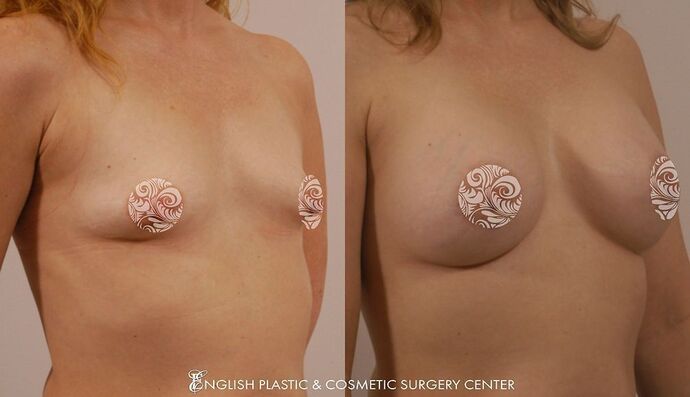 Breast Augmentation/Implants Case 9