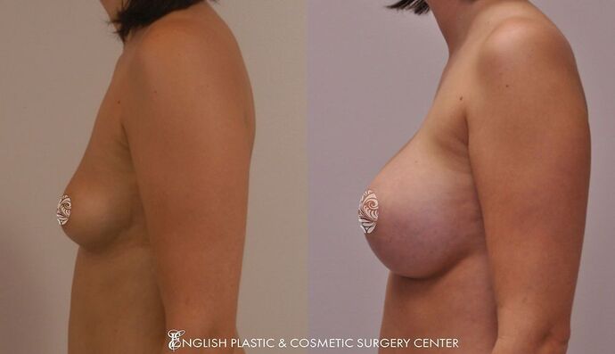 Breast Augmentation/Implants Case 10
