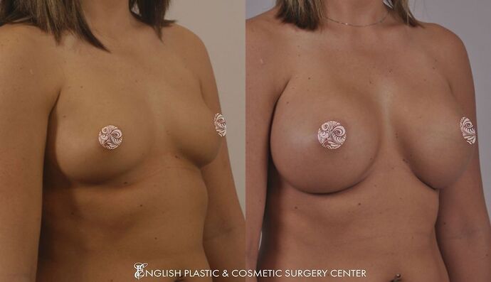 Breast Augmentation/Implants Case 11