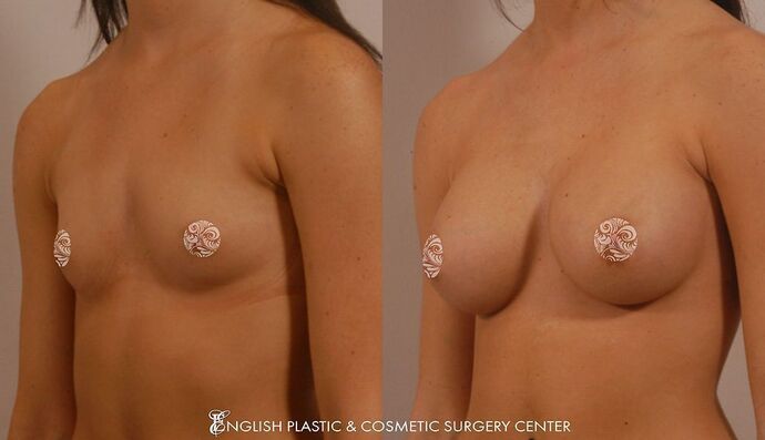 Breast Augmentation/Implants Case 12