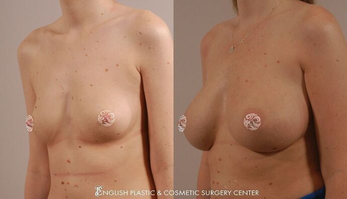 Breast Augmentation/Implants Case 13