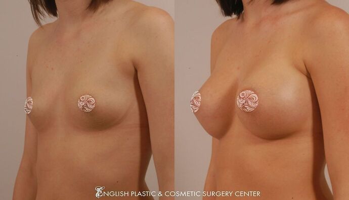 Breast Augmentation/Implants Case 14