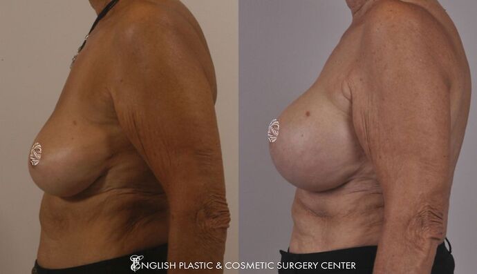 Breast Augmentation/Implants Case 15