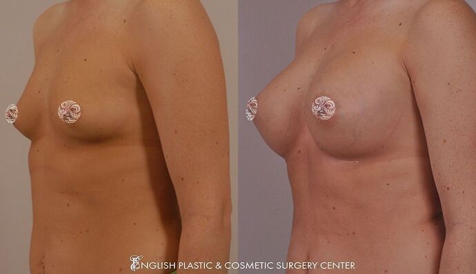 Breast Augmentation/Implants Case 16