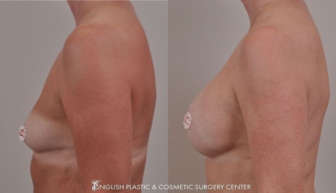 Breast Augmentation/Implants Case 17