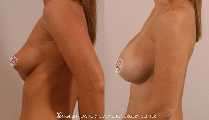 Breast Augmentation/Implants Case 18