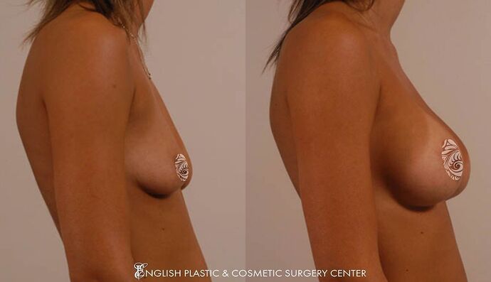 Breast Augmentation/Implants Case 19