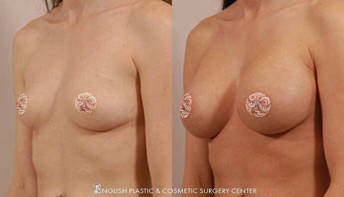 Breast Augmentation/Implants Case 20