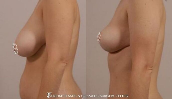 Breast Reduction: Case 1 - Before and After