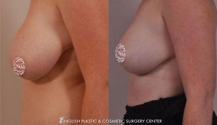 Breast Reduction: Case 2 - Before and After