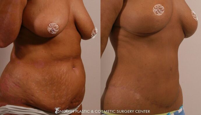 Liposuction: Case 3 - Before and After