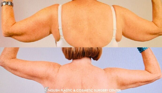 Arm Lift: Case 1 - Before and After