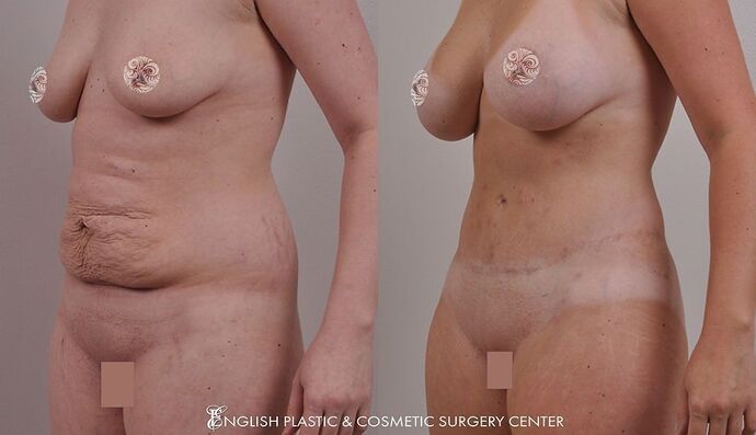 Tummy Tuck Case 2