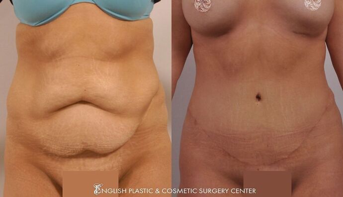 Tummy Tuck Case 3