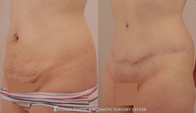 Tummy Tuck Case 4