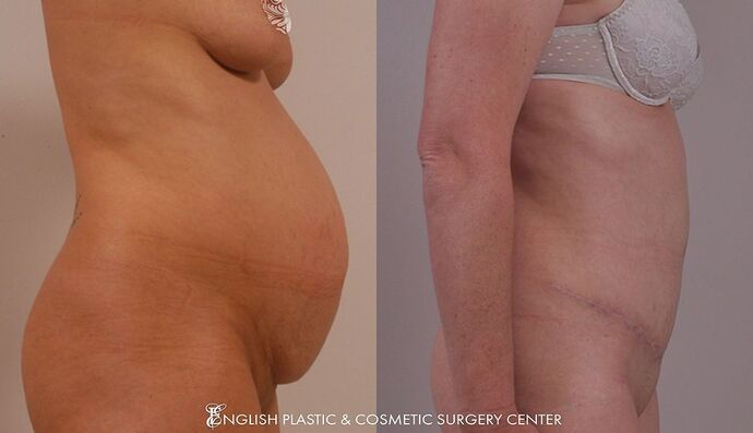 Tummy Tuck Case 5