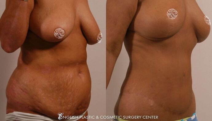Tummy Tuck Case 6