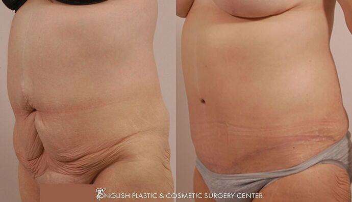 Tummy Tuck Case 7