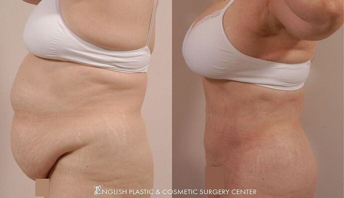 Tummy Tuck Case 8