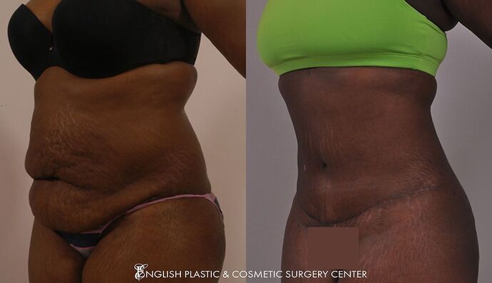 Tummy Tuck Case 9