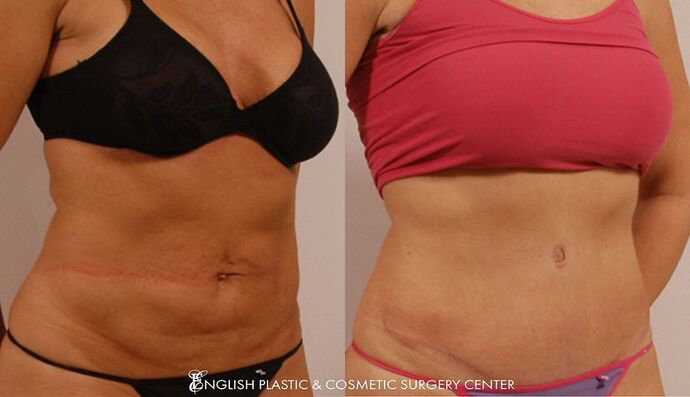 Tummy Tuck Case 10