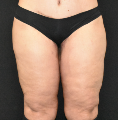 Thigh Lift Case 2 - After