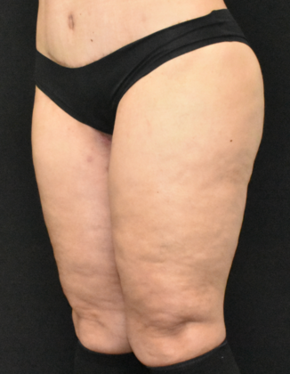 Thigh Lift: Case 2 - After