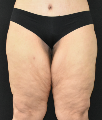 Thigh Lift Case 2 - Before