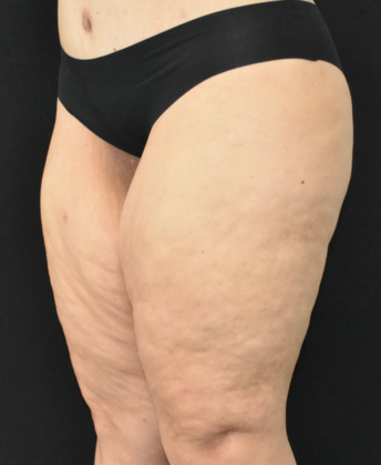 Thigh Lift: Case 2 - Before