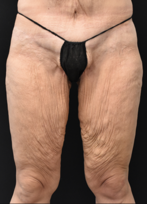 Thigh Lift Case 3 - Before
