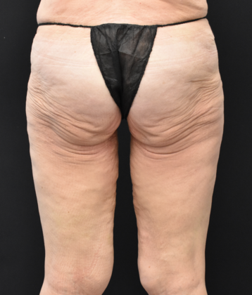 Thigh Lift: Case 3 - Before
