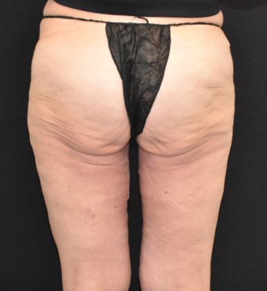 Thigh Lift: Case 3 - After