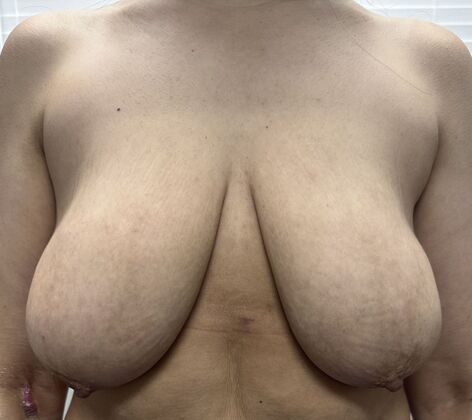 Breast Lift (Mastopexy): Case 237 - Before