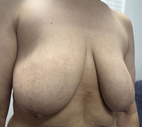 Breast Lift (Mastopexy): Case 237 - Before