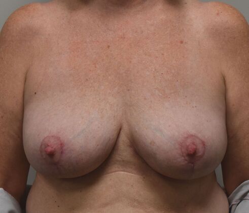Breast Revision: Case 289 - After