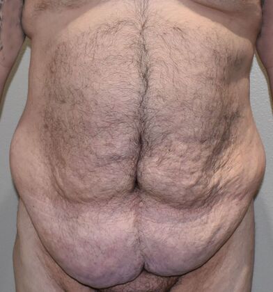 Tummy Tuck (Abdominoplasty) Case 529 - Before