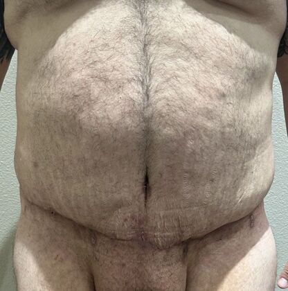 Massive Weight Loss : Case 170 - After